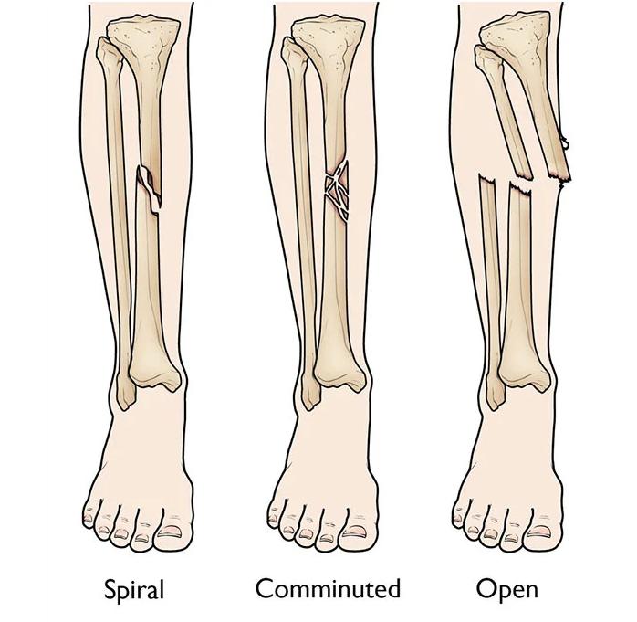 Gãy xương cẳng chân, thời gian hồi phục là bao lâu?