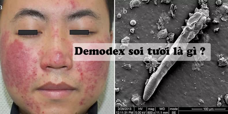 Demodex - gây viêm da lở loét trên mặt người