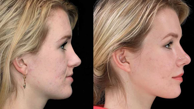 hiệu quả của mewing